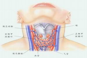 胸內甲狀腺腫