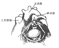 法樂四聯症