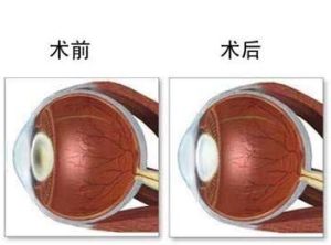 近視眼手術後遺症