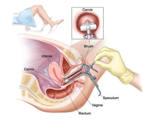 宮頸刮片示意