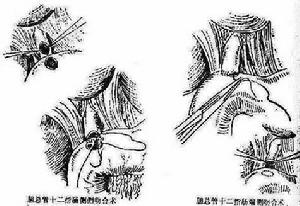 結石性膽囊炎