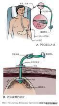 經皮內鏡引導下胃造口術