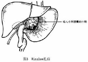 小網膜囊疝 圖3