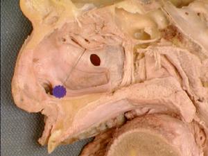 上頜竇裂孔 上頜竇裂孔