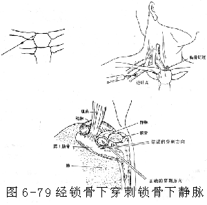 鎖骨下靜脈穿刺插管術