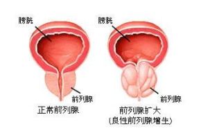 前列腺增生中醫療法