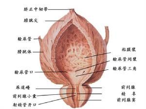 前列腺結石