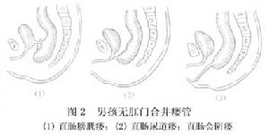 新生兒肛門和直腸畸形