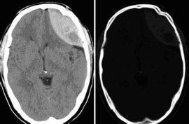 硬膜下血腫