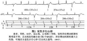 室性並行心律及室性並行心律性心動過速