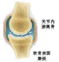 關節軟骨磨損