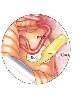 微血管減壓術