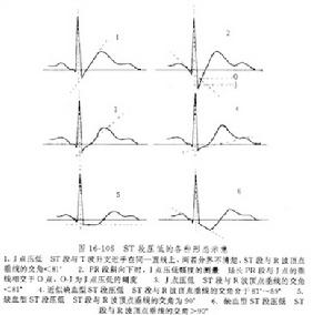 隱匿型冠心病的診斷