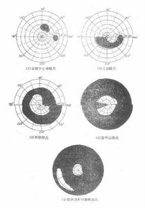 青光眼睫狀體炎危象綜合徵