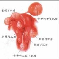 陰道血管肉瘤