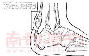 跟腱前囊炎