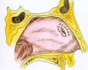 鼻中隔穿孔