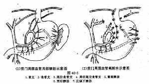 慢性充血性脾腫大