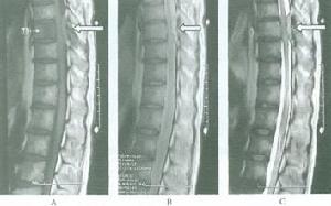 椎管內轉移性腫瘤