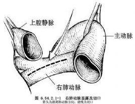 血栓動脈內膜切除術