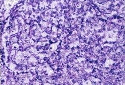 間變性T細胞淋巴瘤