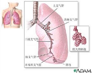 非結核性分枝桿菌病