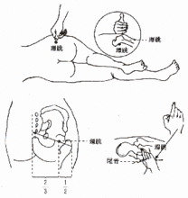 骶骨裂