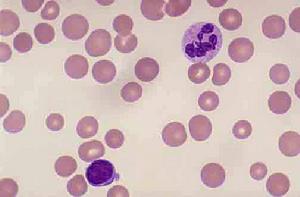 營養性巨幼細胞貧血