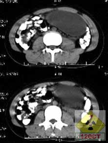 卵巢畸胎瘤影像
