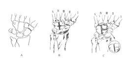 圖2  腕骨局部融合術