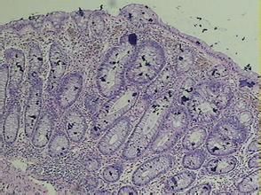 結腸黑變病