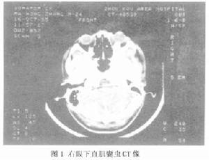 眼外肌豬囊尾蚴病