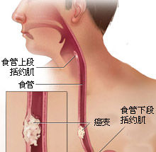 食管癌 