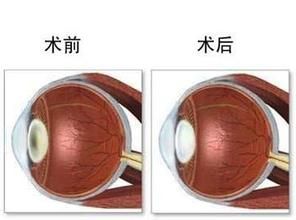 近視眼手術