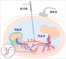 駢胎