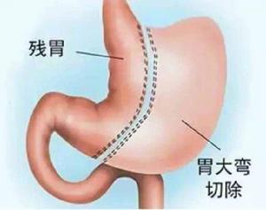 腹腔鏡胃袖狀切除術