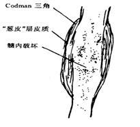 Codman三角