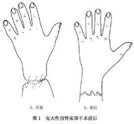 先天性束帶綜合徵 先天性束帶綜合徵