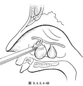 鼻息肉摘除術