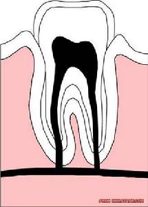 非典型性牙痛