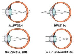 治療近視