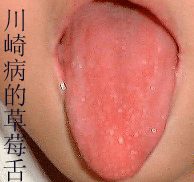 腸麻痹