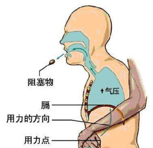 海姆里克腹部衝擊法