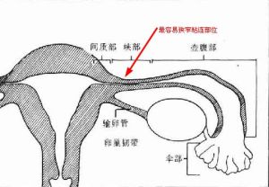 輸卵管通暢檢查