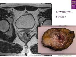 低位直腸癌
