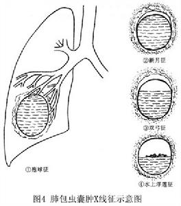 肺包蟲病