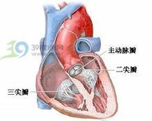 繼發孔型房間隔缺損