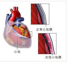心包填塞