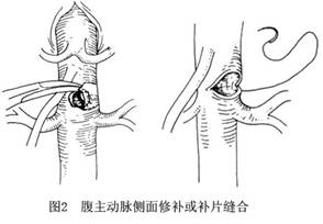 腹部大血管損傷