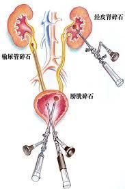 中老年人泌尿系統感染